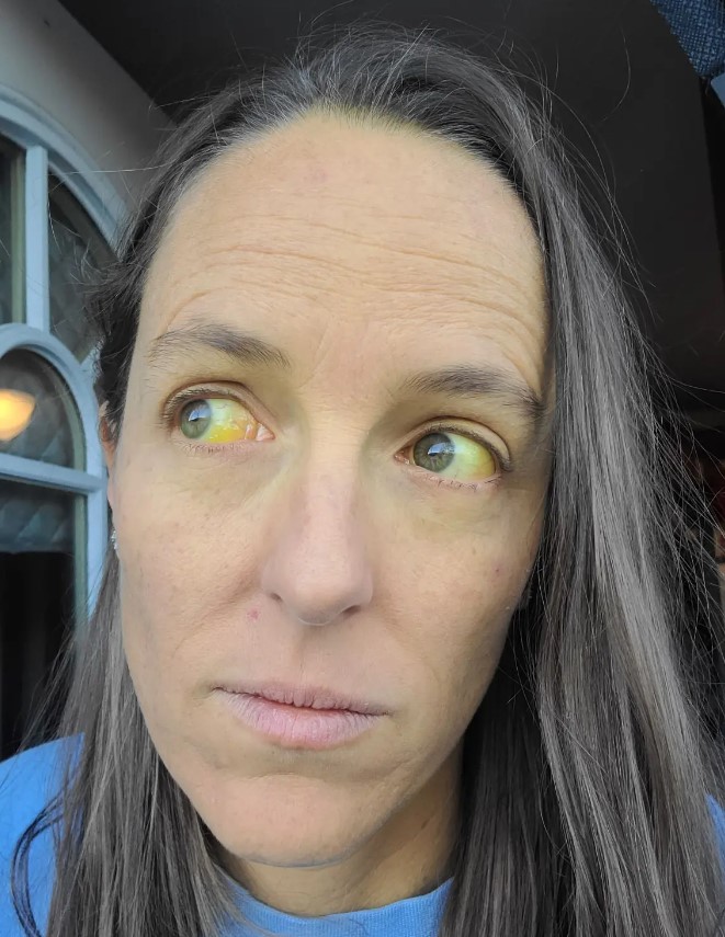 Woman suffers weird yellow eyes after taking herbal remedy for menopause 2