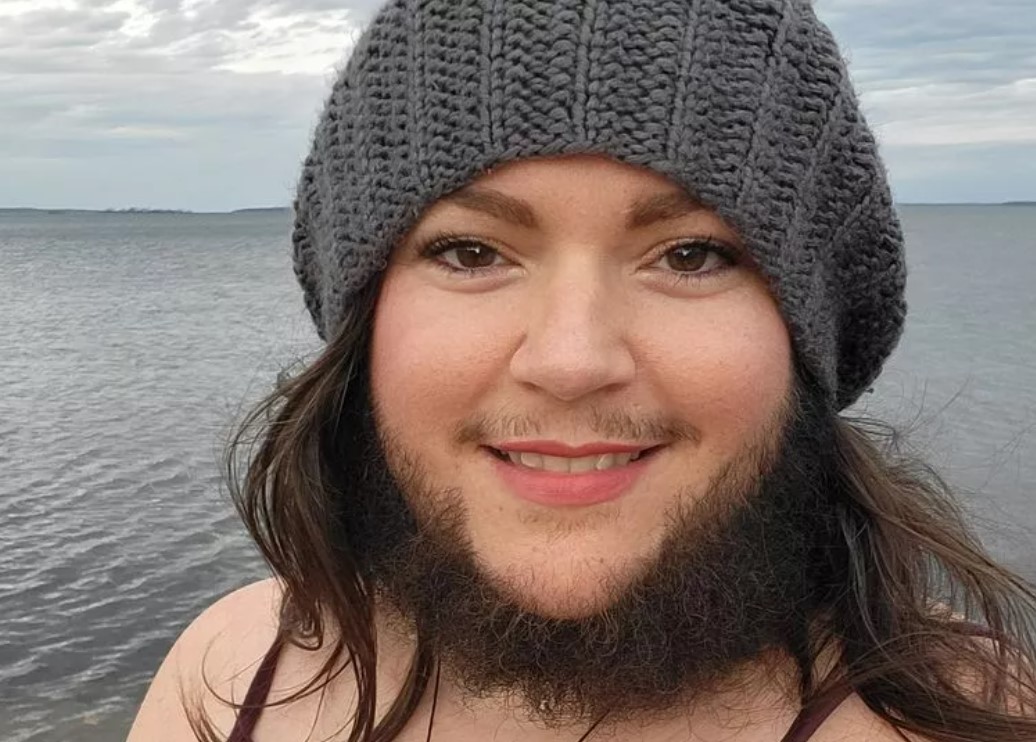 Woman who was bullied due to her naturally bushy beard decided to grow out her whiskers 1