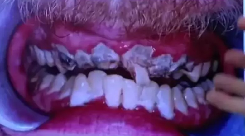 Man left people stunned after showing off his teeth that had not been brushed for 20 years 3