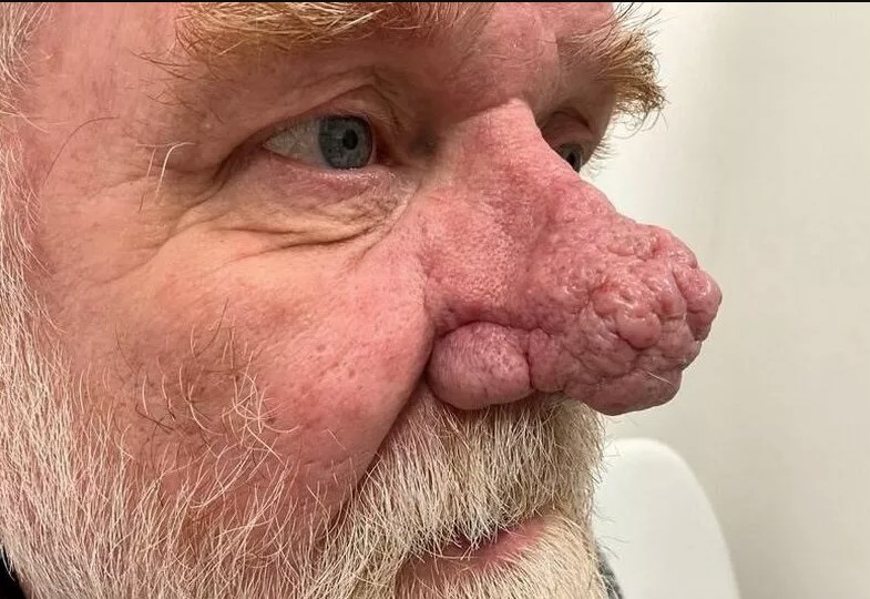 Man with 'Elephant Man' growth on his nose doesn't dare go out without his motorcycle helmet 1