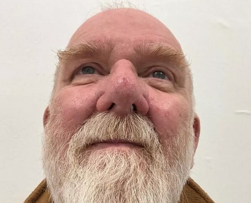 Man with 'Elephant Man' growth on his nose doesn't dare go out without his motorcycle helmet 3