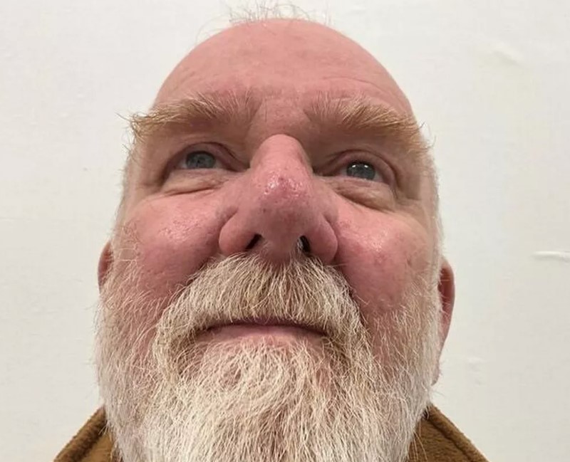 He finally had the tumor removed from his nose. Image credit: Ever Clinic/SWNS