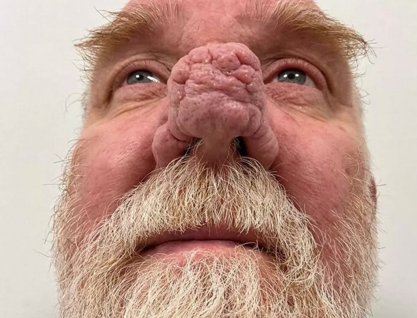 Man with 'Elephant Man' growth on his nose doesn't dare go out without his motorcycle helmet 2