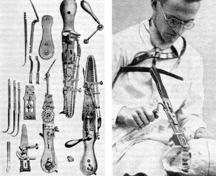 Chainsaws were once used by doctors during cesarean sections, causing high mortality rates. Image Credit: Getty