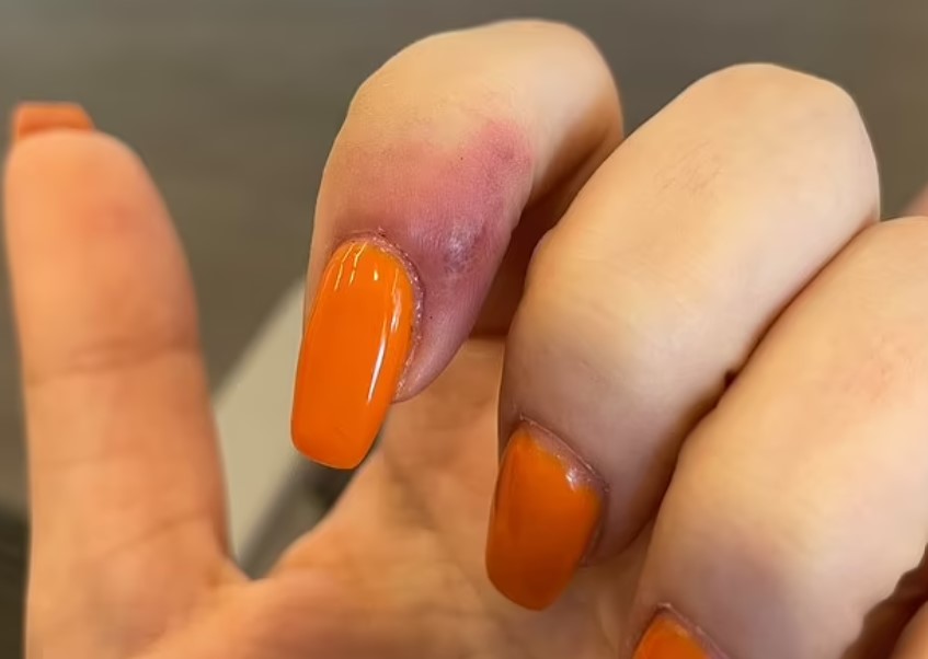 Young girl sues nail salon for $1.75M as she got herpes after getting her nails done there 2