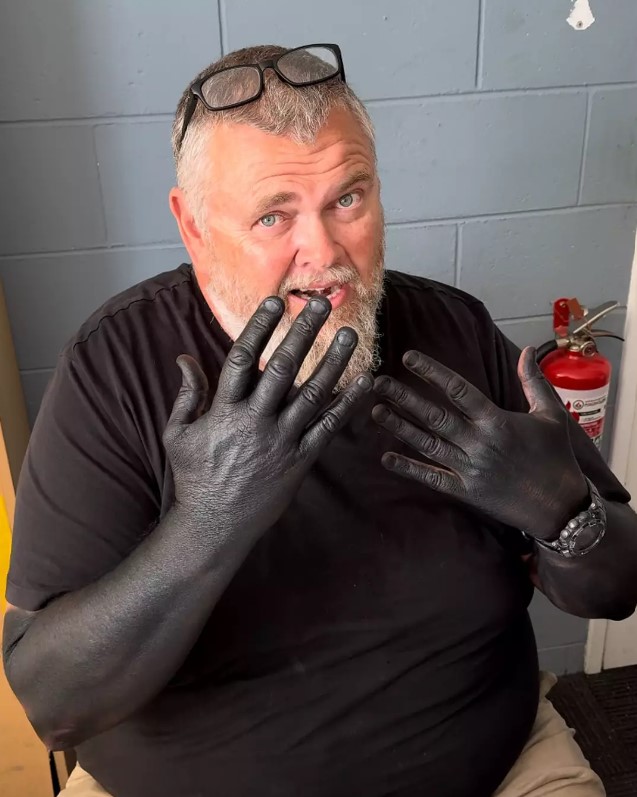 Man suffered awful outcome after five days as he rubbed squid ink on himself 4