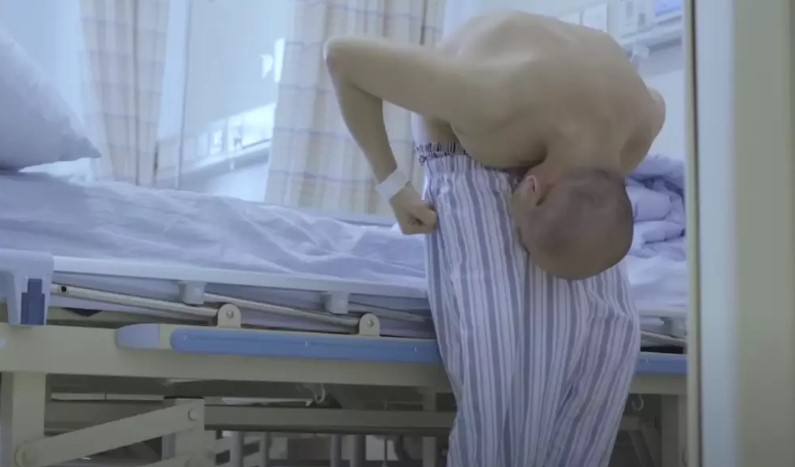 Man who was bent over for 28 years finally had surgery to stand up straight 2