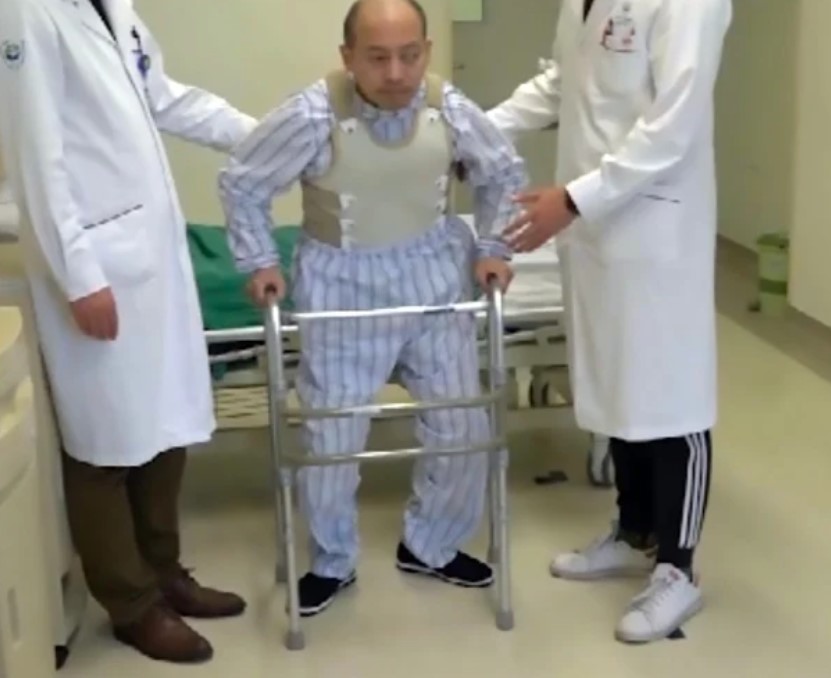 Man who was bent over for 28 years finally had surgery to stand up straight 6