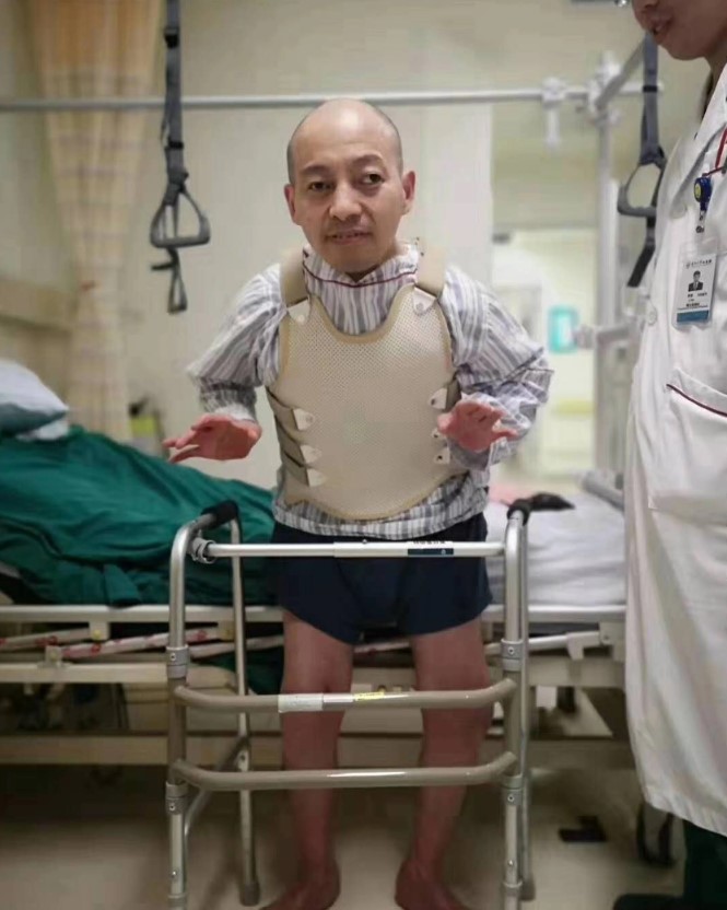 Man who was bent over for 28 years finally had surgery to stand up straight 5
