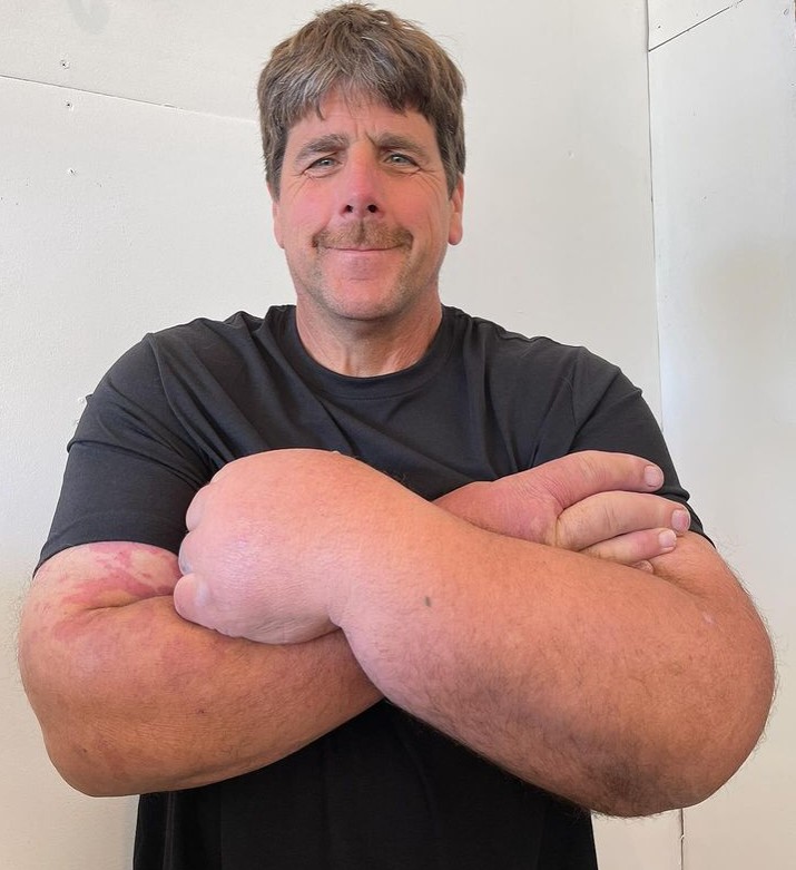 Man born with giant arms and hands has left people baffled for years 6