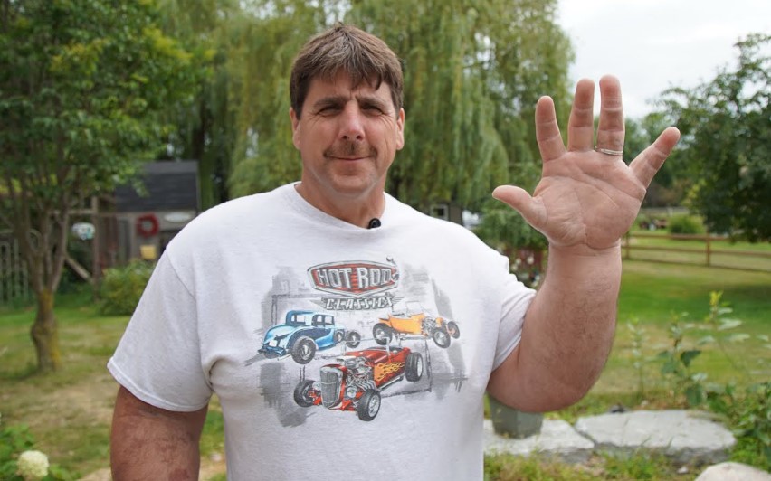 Man born with giant arms and hands has left people baffled for years 5