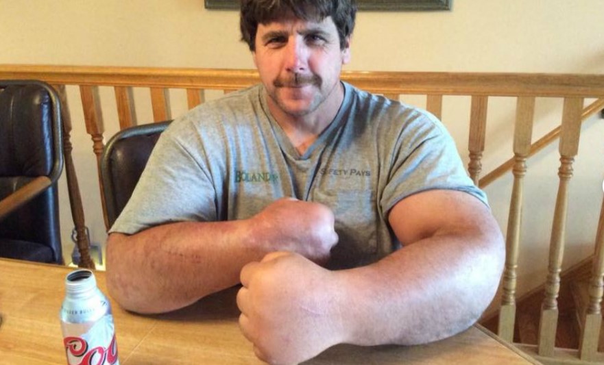 Man born with giant arms and hands has left people baffled for years 3