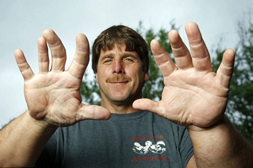 Man born with giant arms and hands has left people baffled for years 1