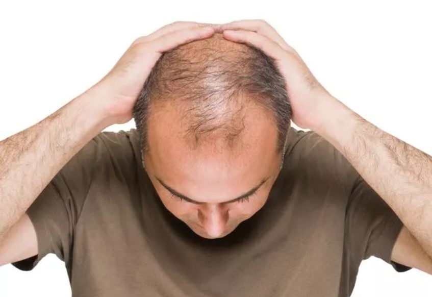 The study offers promise for halting balding progression in those currently experiencing hair loss. Image Credit: Getty