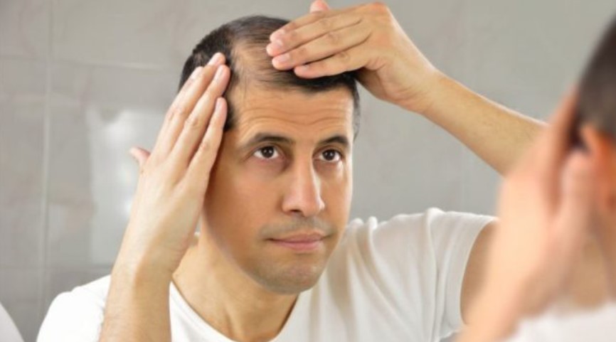 Hair loss is a common concern, particularly among men. Image Credit: Getty