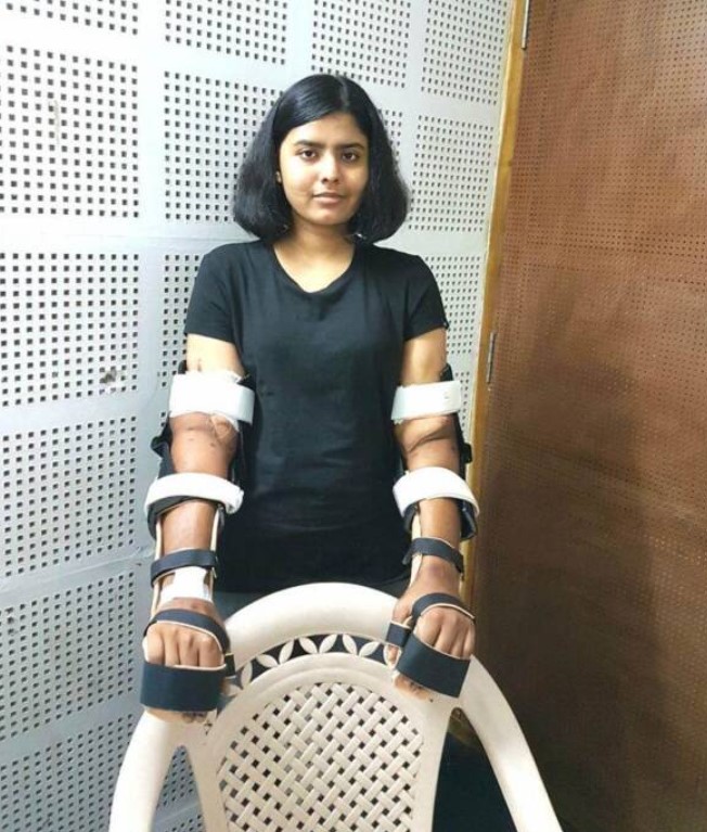 Shreya Siddanagowder became the world's first woman to undergo a hand transplant from a man. Image Credit: Supplied