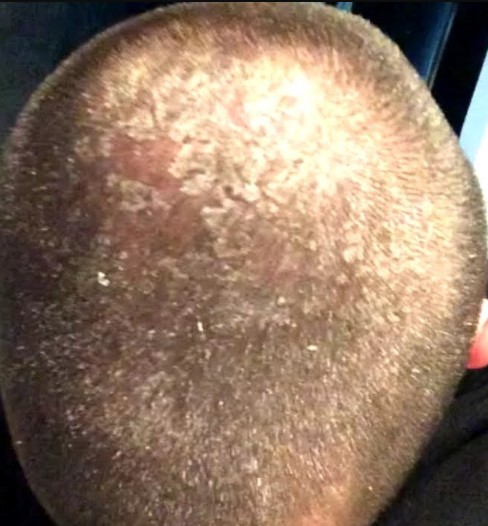 Prior to the experiment, Aidan's regular shampoo use caused scalp issues. Image Credit: YouTube/Garden of Aidan