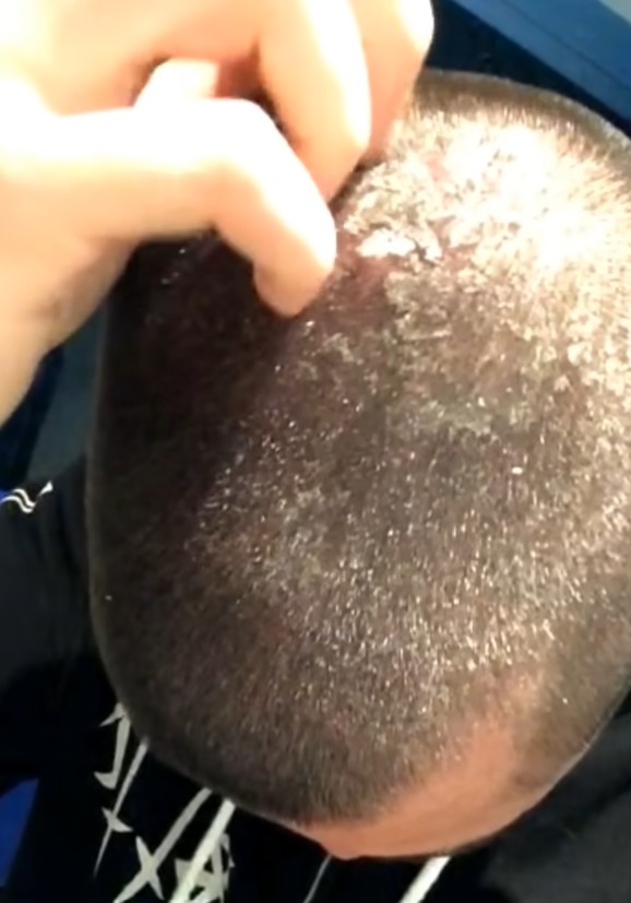Aidan decided to quit shampoo to address his scalp problems.Image Credit: YouTube/Garden of Aidan
