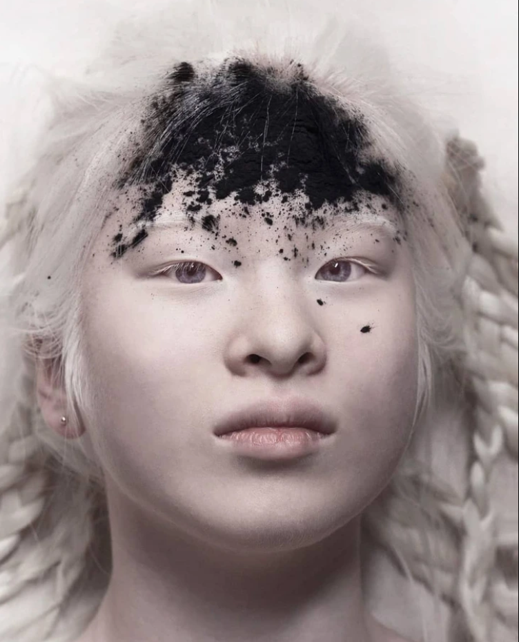 Xueli Abbing: Abandoned baby because of albinism becomes a Vogue model 2