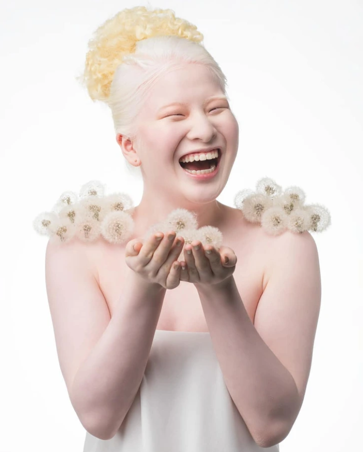 Xueli Abbing: Abandoned baby because of albinism becomes a Vogue model 4