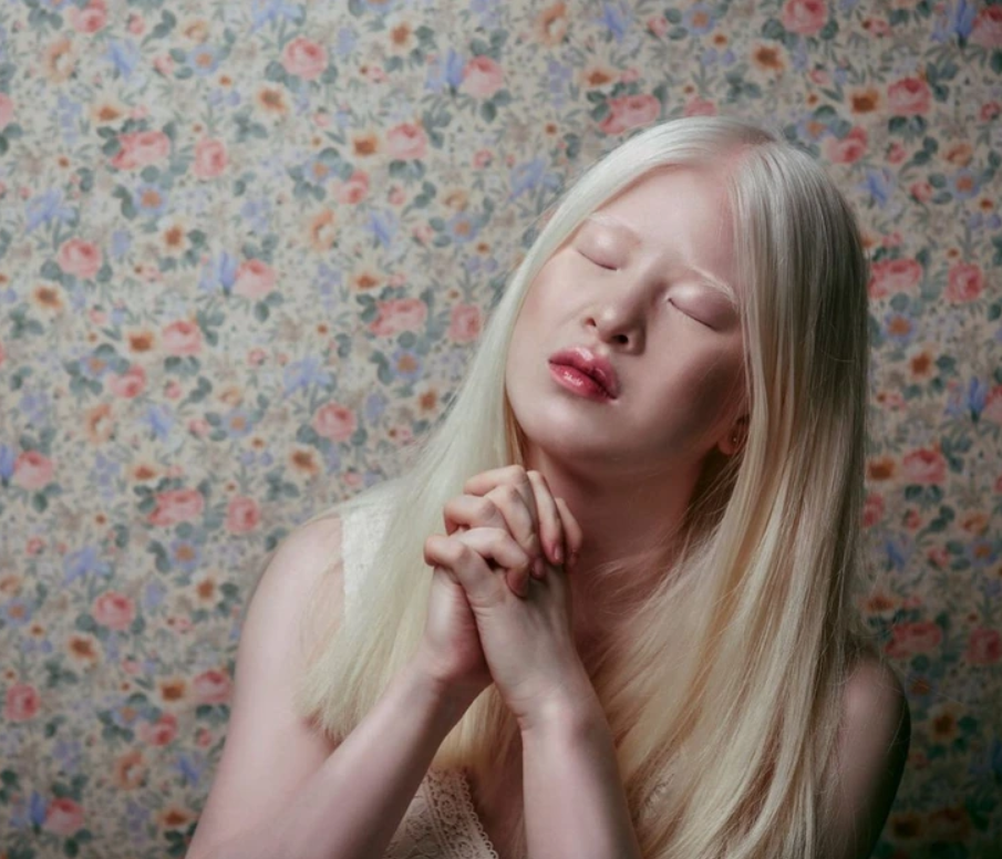 Xueli Abbing: Abandoned baby because of albinism becomes a Vogue model 5