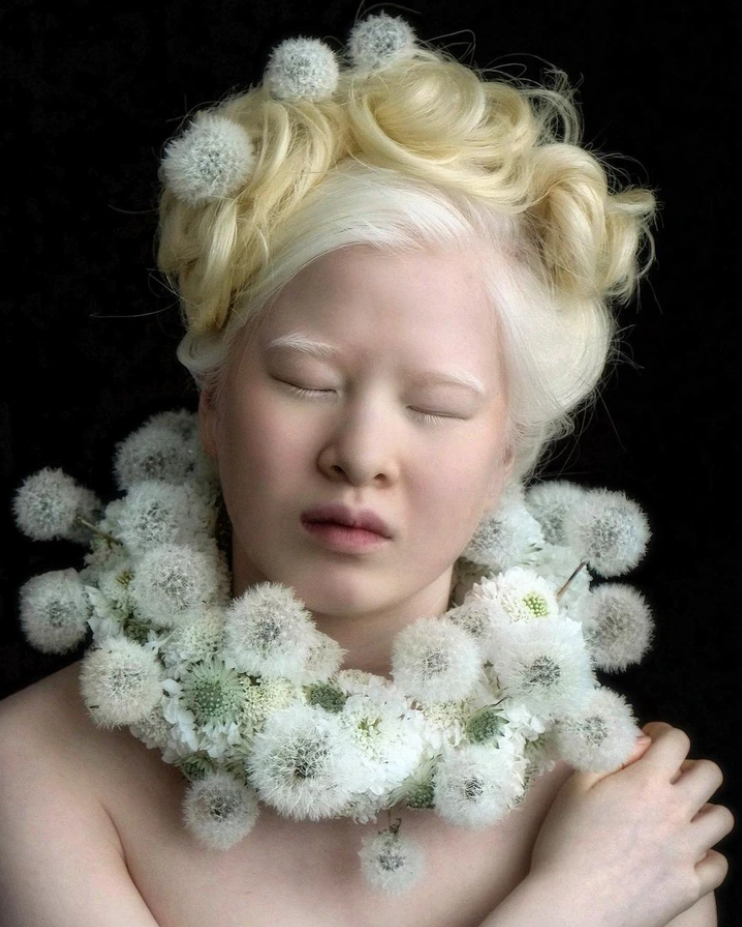 Xueli Abbing: Abandoned baby because of albinism becomes a Vogue model 6