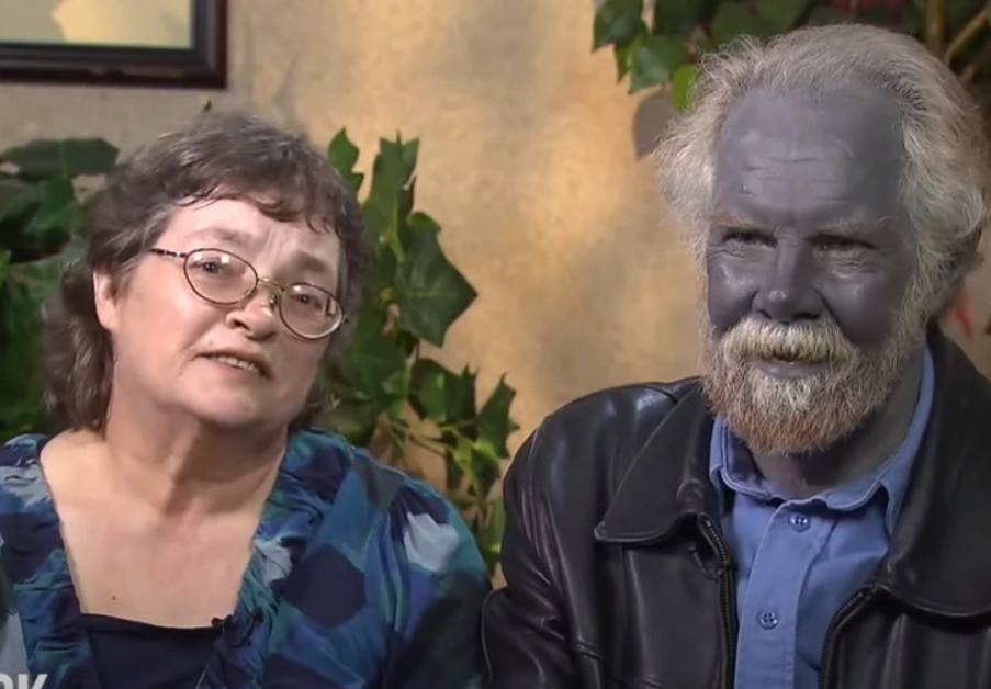 A man turned blue after long-term use of dietary supplements 2