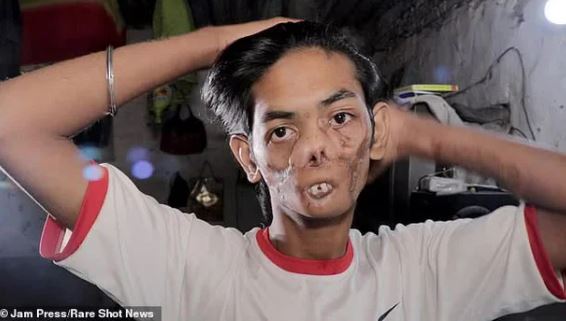 The 18-year-old boy is shunned by the villagers and called 'the ghost boy' because of his disfigured appearance 3