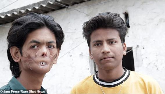 The 18-year-old boy is shunned by the villagers and called 'the ghost boy' because of his disfigured appearance 4