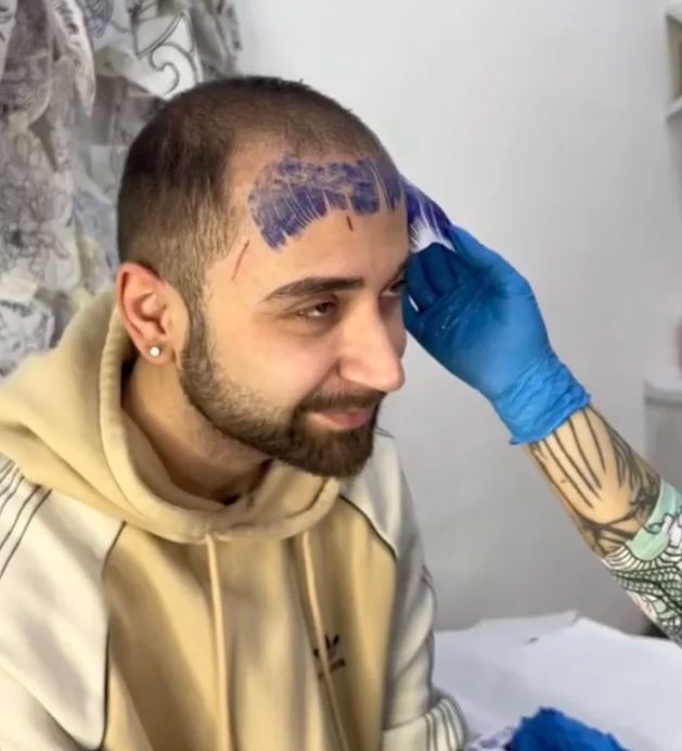 Balding man gets fringe tattoo to cover hairline, breaks down in tears at result 2