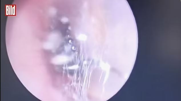 Shocking moment: Doctors discover spider and its colony of babies living in woman's ear 2