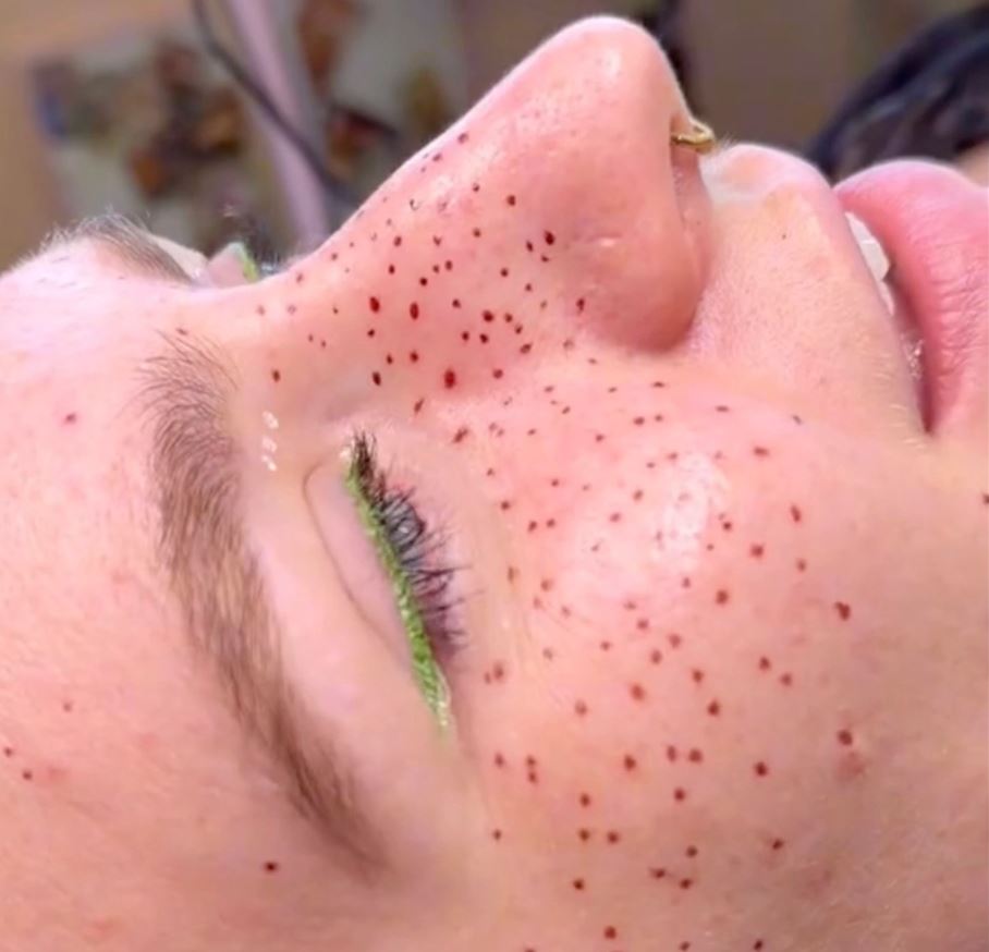 A woman gets fake freckles tattooed, with some predicting that they will 'age like a tramp stamp' 3