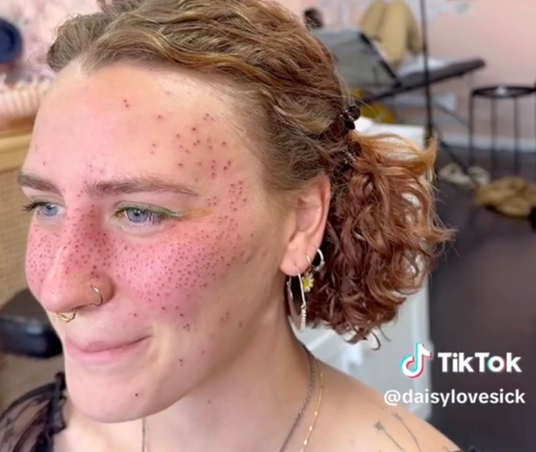 A woman gets fake freckles tattooed, with some predicting that they will 'age like a tramp stamp' 5