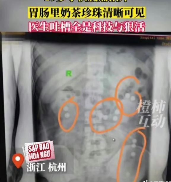 Man low back pain gets an X-ray, discovers his stomach is filled with pearl milk tea 2