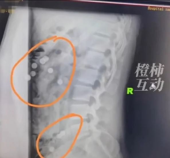 Man low back pain gets an X-ray, discovers his stomach is filled with pearl milk tea 3
