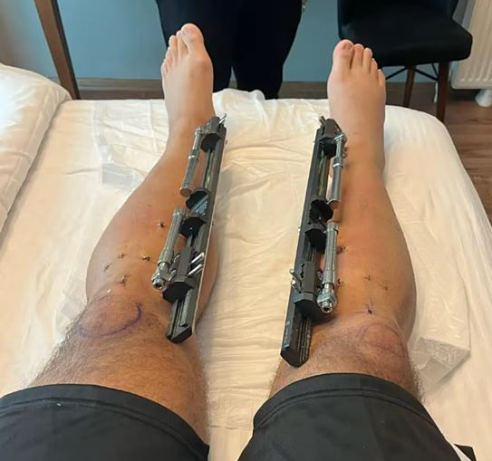 The man spent $100K on leg-lengthening, gaining 7 inches despite the pain, to rise above 2m 2