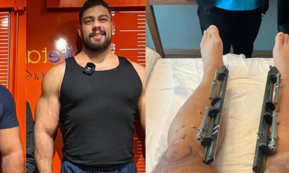 The man spent $100K on leg-lengthening, gaining 7 inches despite the pain, to rise above 2m 3