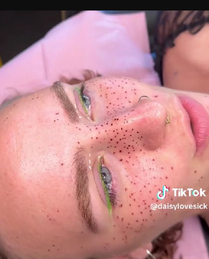Internet divided over trend of tattooing 'permanent freckles' on the face 2