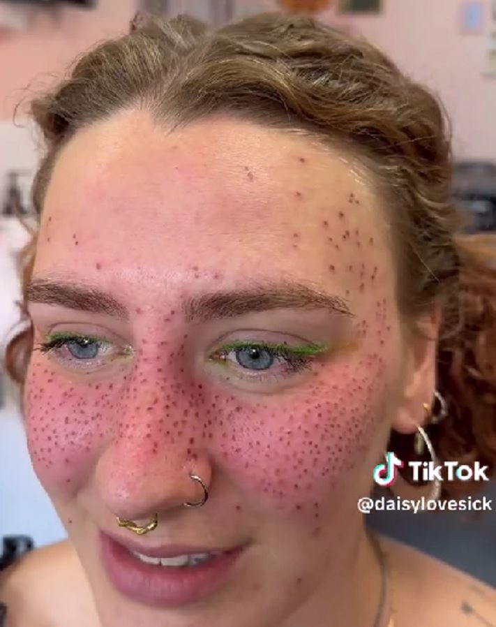 Internet divided over trend of tattooing 'permanent freckles' on the face 3