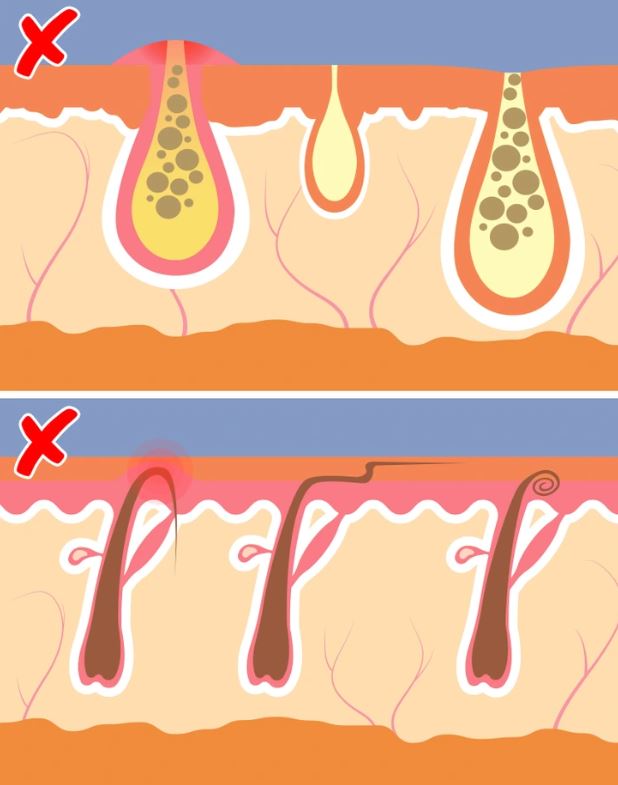 Avoid shaving your body hair and you may be less likely to get acne.