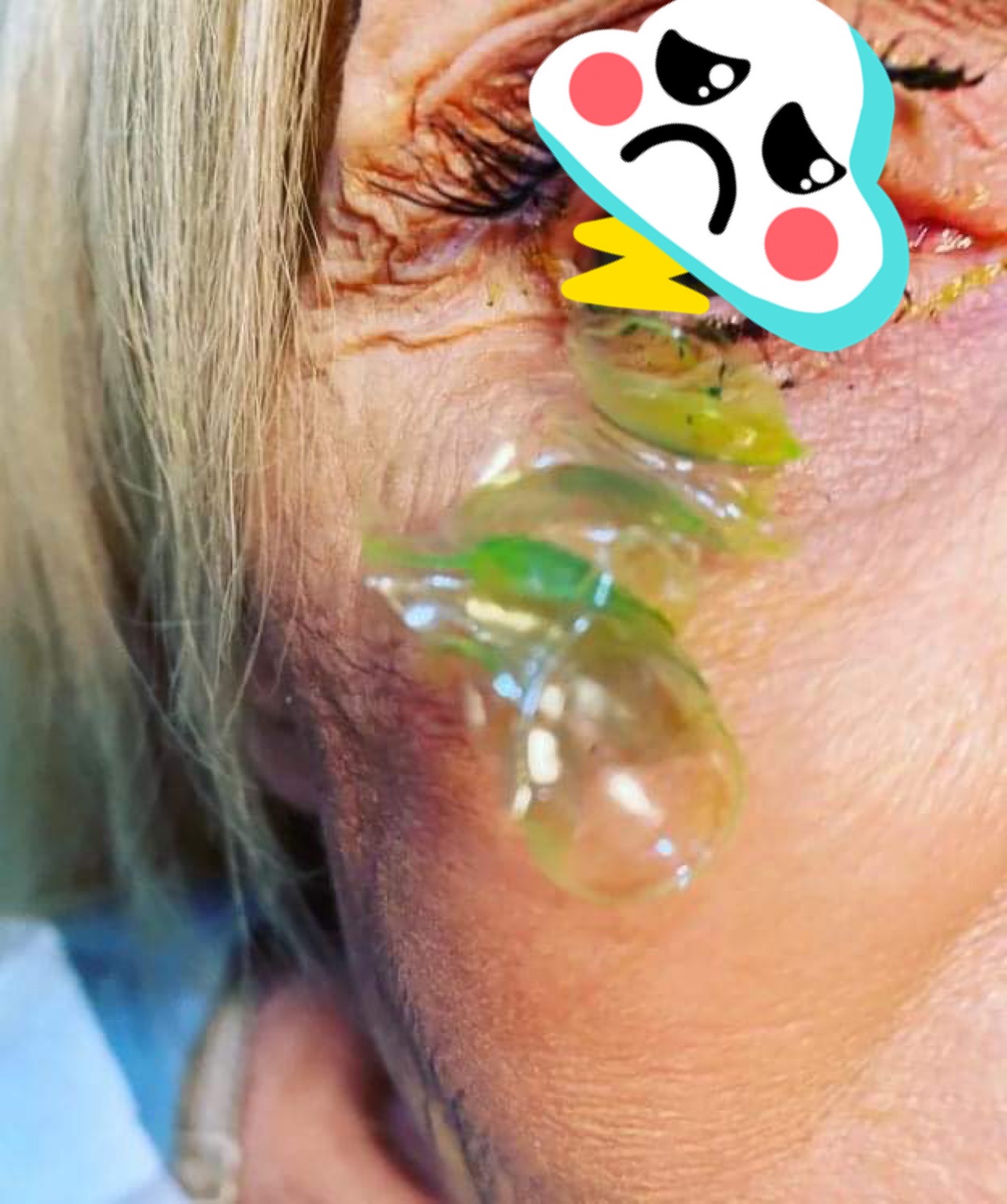 Doctor removes 23 contact lenses from woman who wore them during sleep 1