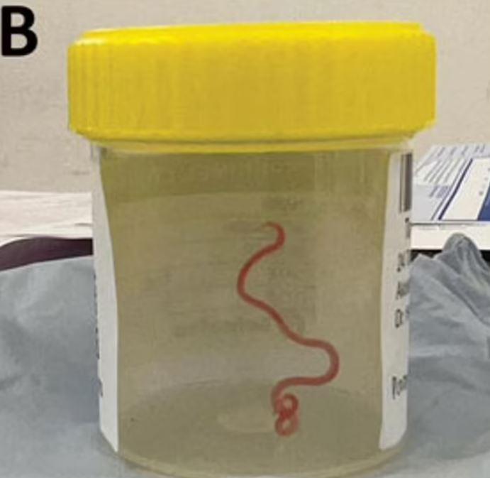 Doctors were left stunned by a live parasitic worm found in woman’s brain: ‘It’s alive!’ 2