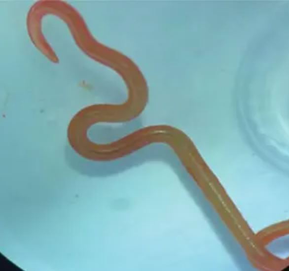 Doctors were left stunned by a live parasitic worm found in woman’s brain: ‘It’s alive!’ 3