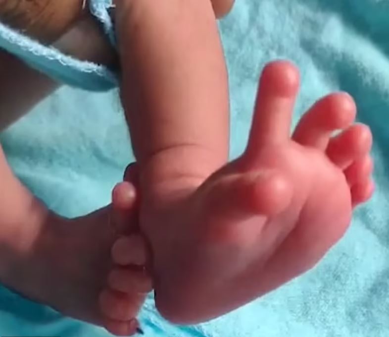 Baby born with 14 fingers and 12 toes hailed as ‘second coming of Hindu goddess’ 4