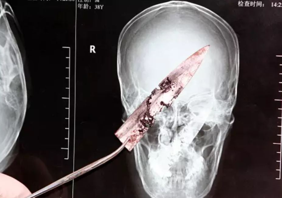 Doctor was stunned after discovering a knife in man's head for four years 2