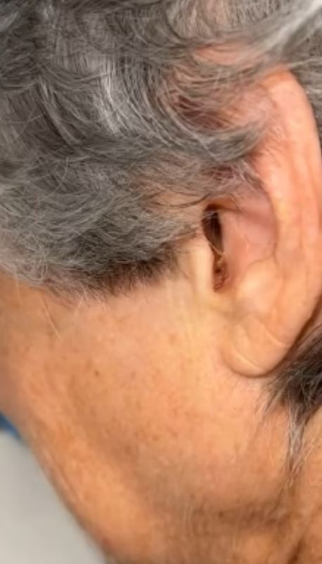 Moment insects removed from mum's blocked ear leave people unable to sleep 3