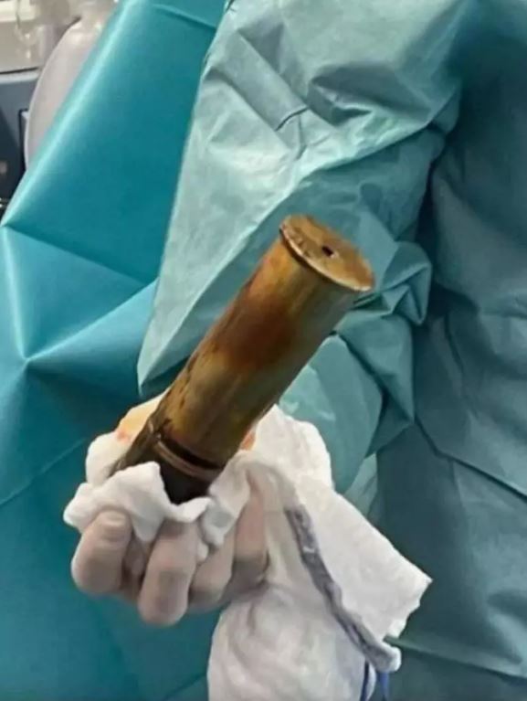 Hospital evacuated after an 88-year-old man arrives with a World War I artillery stuck in rectum 1