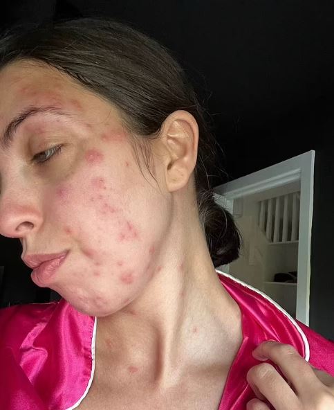 Holidaymaker covered in a HUNDRED bedbug bites after trip - the worst case doctor had EVER seen 1