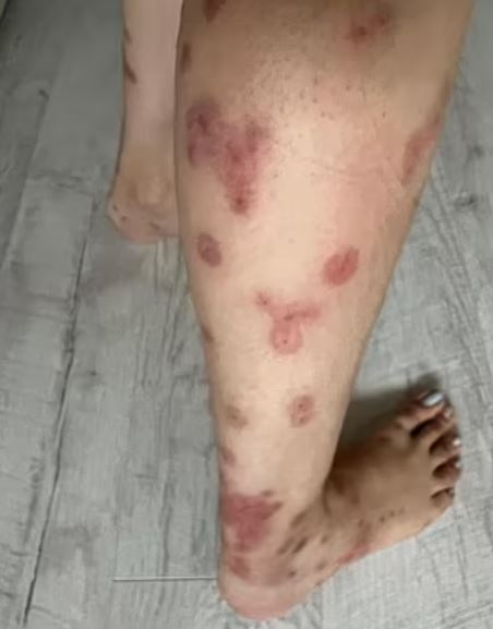 Holidaymaker covered in a HUNDRED bedbug bites after trip - the worst case doctor had EVER seen 2