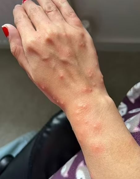 Holidaymaker covered in a HUNDRED bedbug bites after trip - the worst case doctor had EVER seen 3